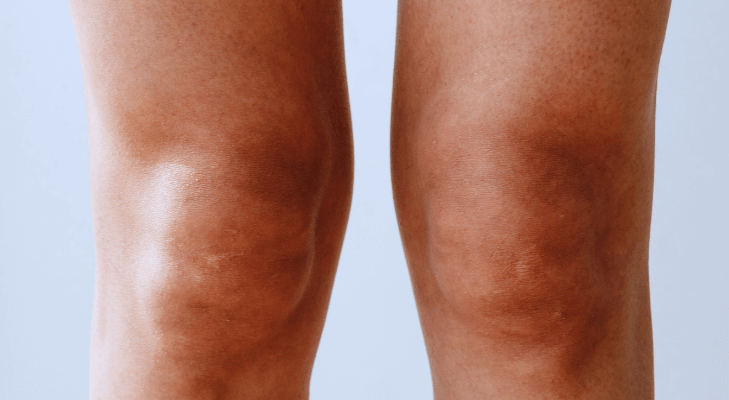 肘・膝の黒ずみを薄くするには？重曹やニベアよりも効果的な方法アンチエイジングの神様