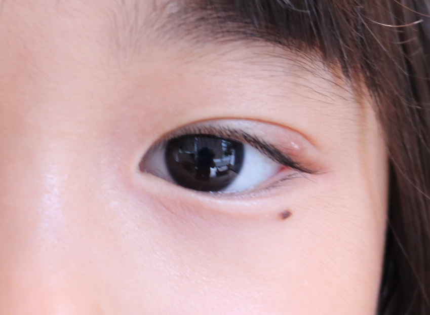 霰粒腫 ものもらい まぶたに関わる治療東京都 八王子市の霰粒腫 ものもらい の治療なら八王子友愛眼科へ