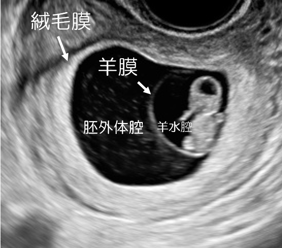 双子の妊娠で起こるバニシングツインとは？ - 新型出生前診断 NIPT Japan