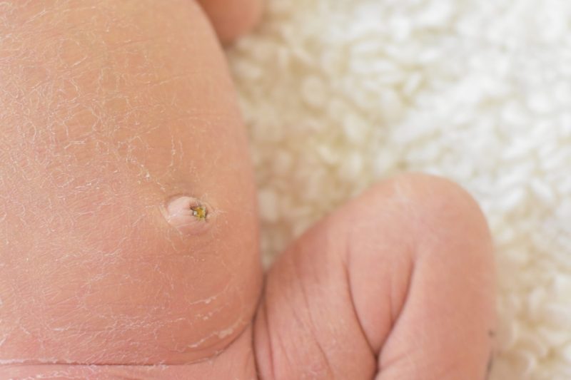 臍炎、尿膜管遺残症の治療について医療法人社団實理会 東京国際大堀病院