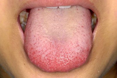 舌苔 ぜったいみんなの医療ガイド兵庫医科大学病院