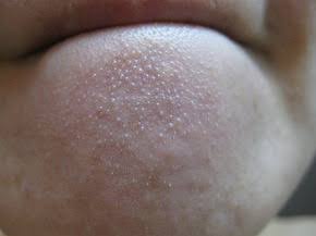 顎のザラザラはひどい角栓が原因！9つの取り方をおきゃんママが徹底解説若見えラボ