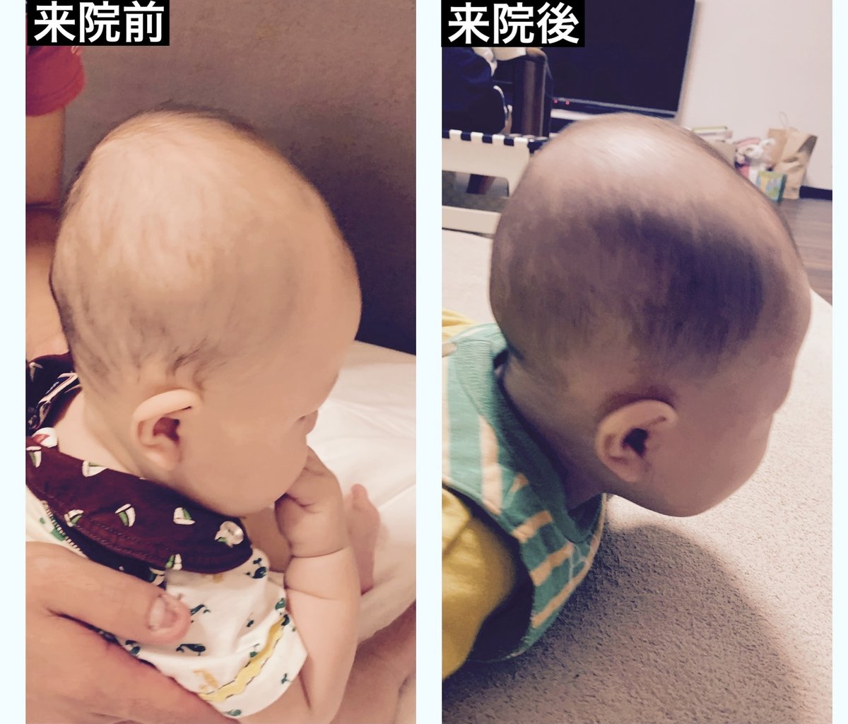 あなたの赤ちゃんは順調？月齢別で見る頭の大きさと成長のチェック法 - 関西 赤ちゃんの頭のかたち外来