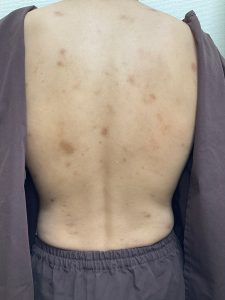 ５０年来の全身アトピー・背中大阪・茨木市 重度のアトピー専門鍼灸 悠々堂まき鍼灸院