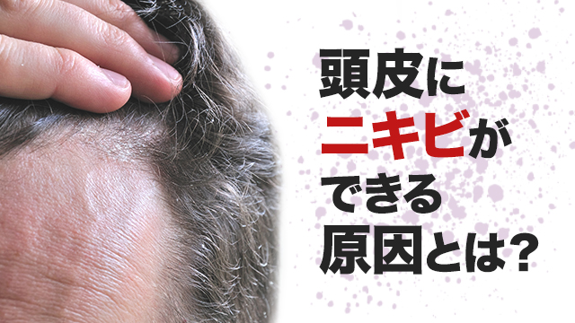 頭皮ニキビはなぜできるの？皮膚科の先生に聞いた頭皮ニキビの原因と対策を紹介 - OZmall