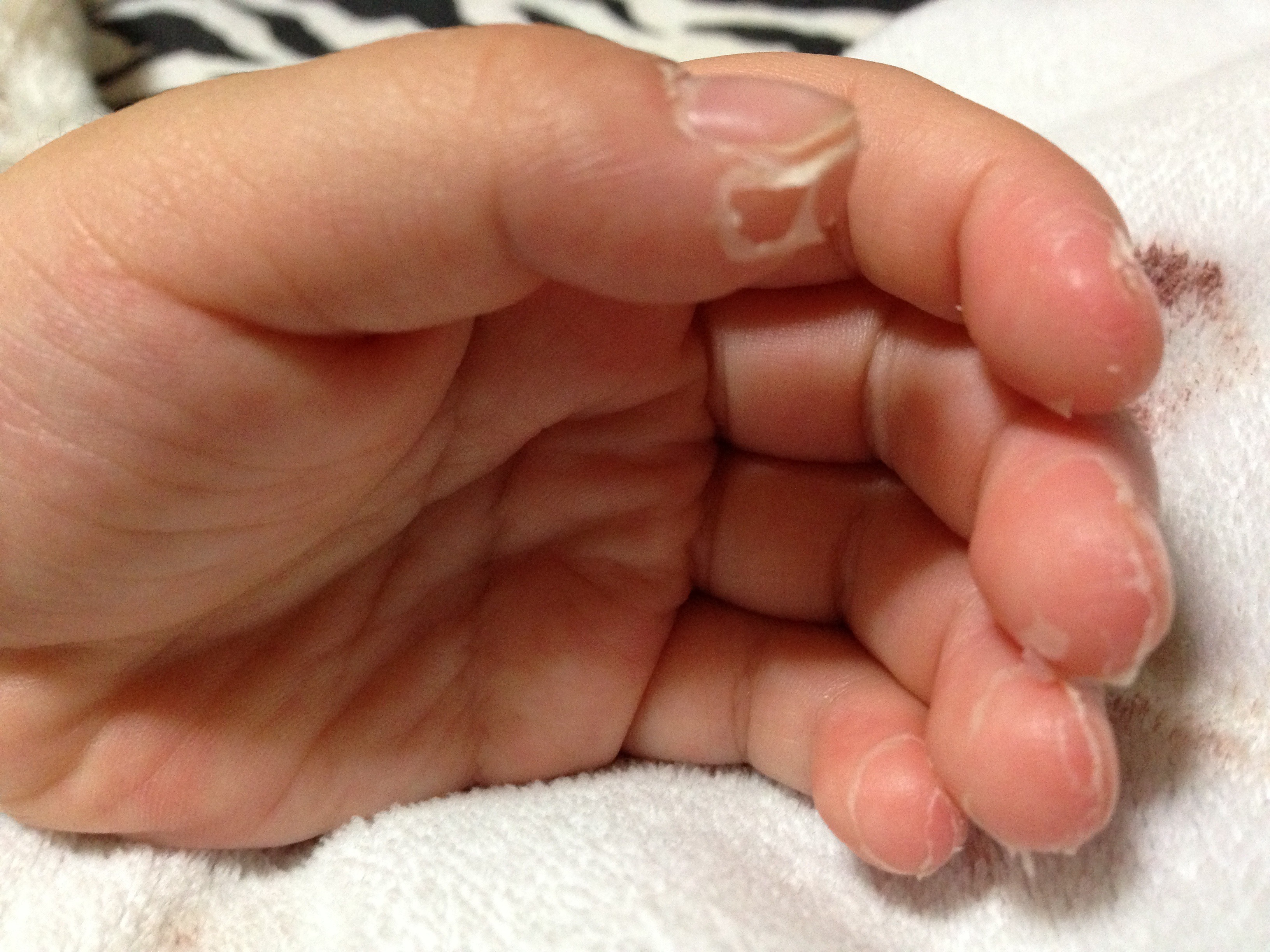 新生児の皮がむける「新生児落屑」って？赤ちゃんの体の特徴について 助産師監修公式 SOLIA SHOP