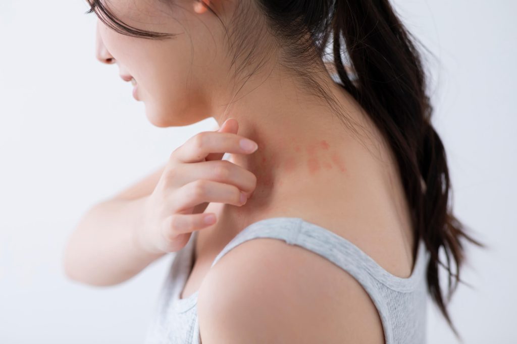 原因不明の方 原因不明の発疹、痒み 当院へお越しの患者様へあま市・名古屋市の皮膚科 ごとう皮フ科クリニック