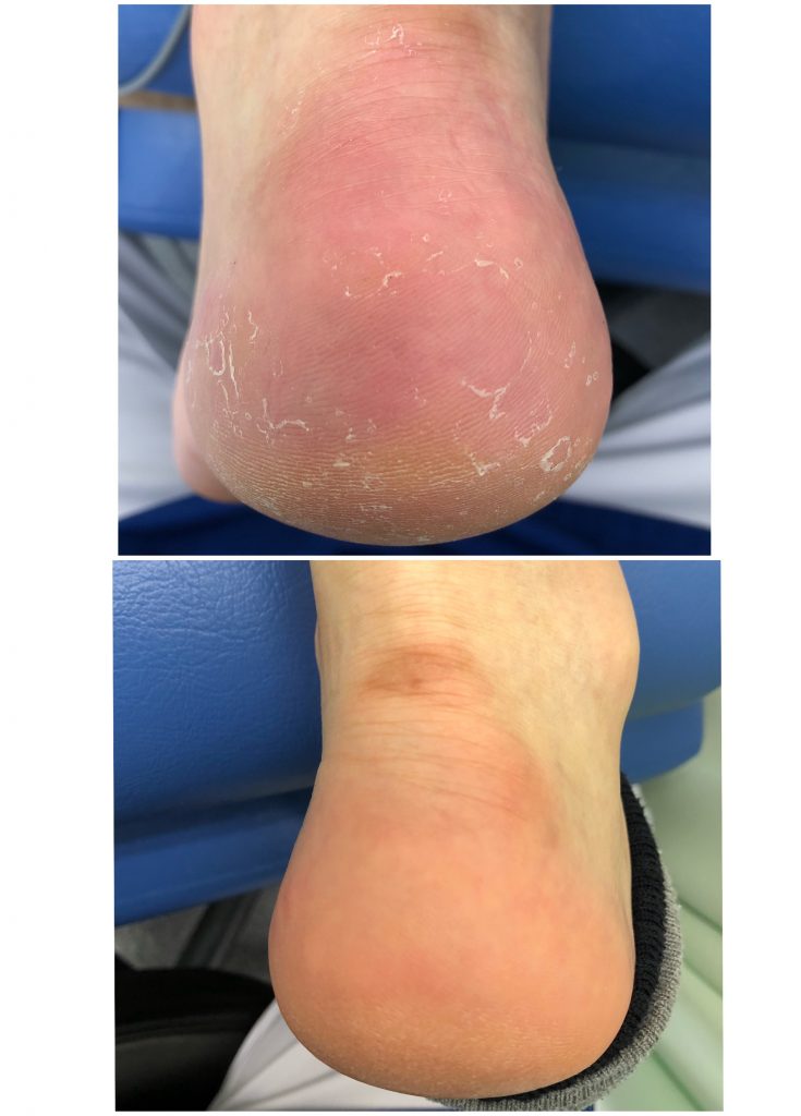 かかとの痛みは痛風が原因？症状・治療法を徹底解説公式 EMISHIA CLINIC 丨 エミシアクリニック