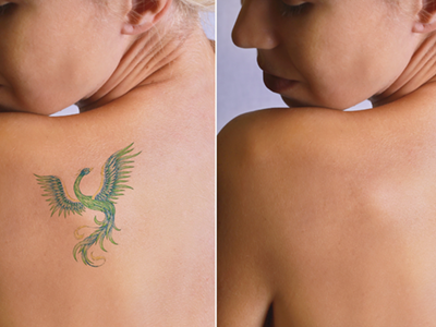 入れ墨 刺青 ・タトゥー除去美容整形の 共立美容外科