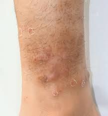 アトピー性皮膚炎基礎知識東京都アレルギー情報navi