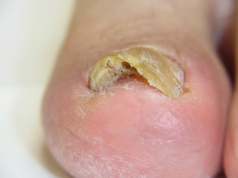 知って得する病気の話_爪の病気について 皮膚科彦根市立病院