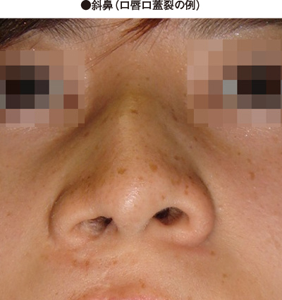 斜鼻修正のデメリットを医師が解説美容整形は東京シンデレラ美容外科 新宿 池袋 大宮