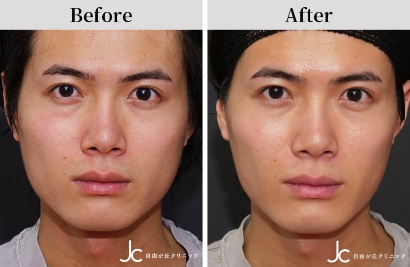 男性のエラボトックスの症例写真。注入した箇所の筋肉の働きを止めることができる施術東京・赤坂の美容外科イートップクリニック