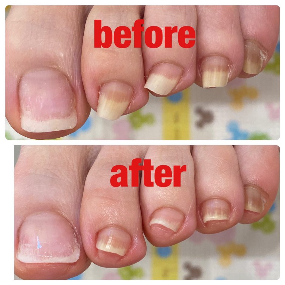 巻き爪の予防方法とセルフケア 巻き爪予防のために自分でできることは？Q＆A痛くない巻き爪補正 初日で痛みが取れる大阪市淀川区ペディグラス