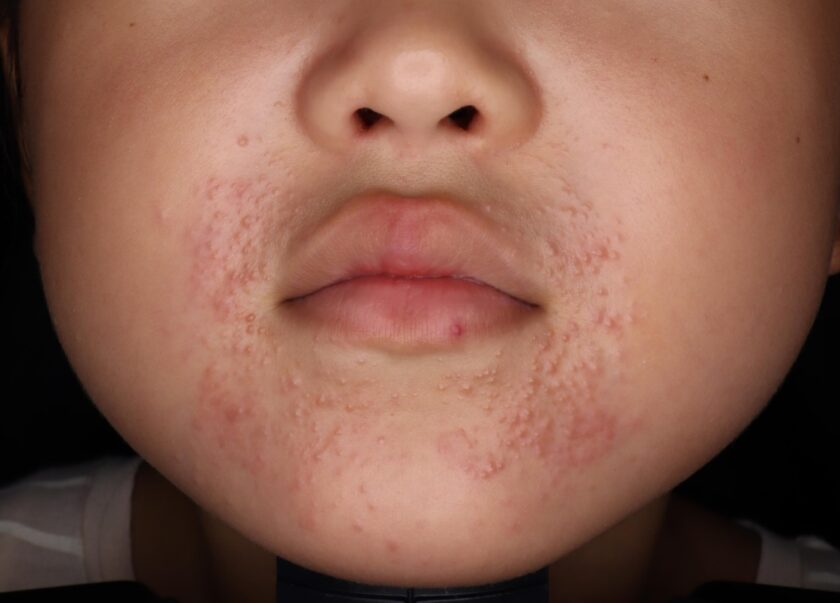 小学生の毛穴詰まりについて小学校高学年の娘の毛穴詰まりに悩んでい- Yahoo!知恵袋