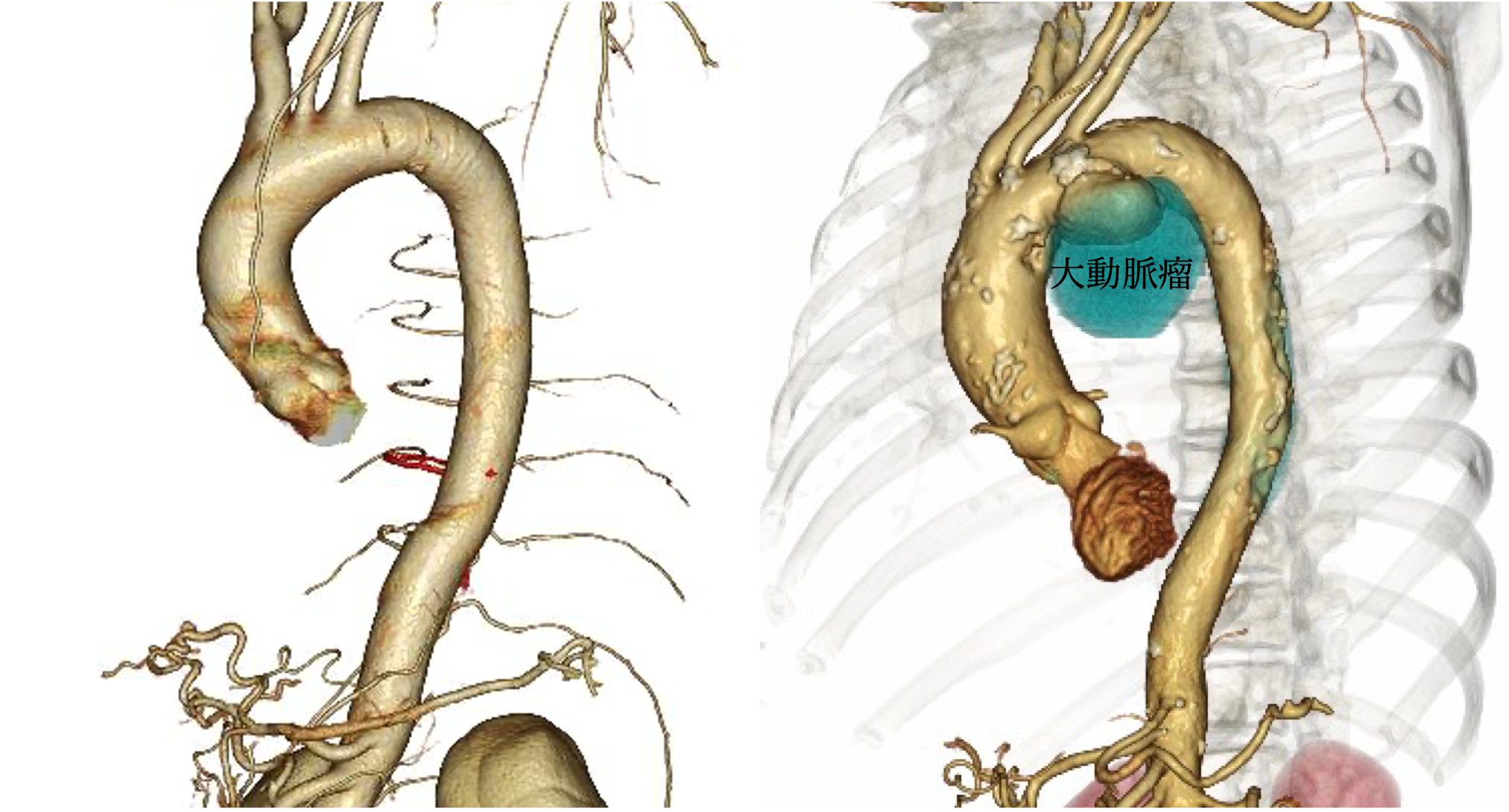 心血管疾患 大動脈瘤・大動脈解離日本ライフライン株式会社