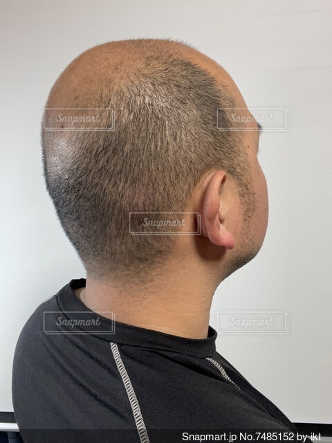 ハゲて悩みすぎて病院に行った話 & その時の写真と動画を公開w