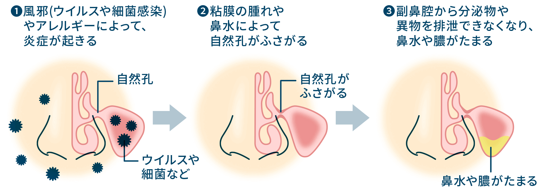 黄色い鼻水 ネバネバ・サラサラの鼻水 が出る原因と治療法について医師が解説