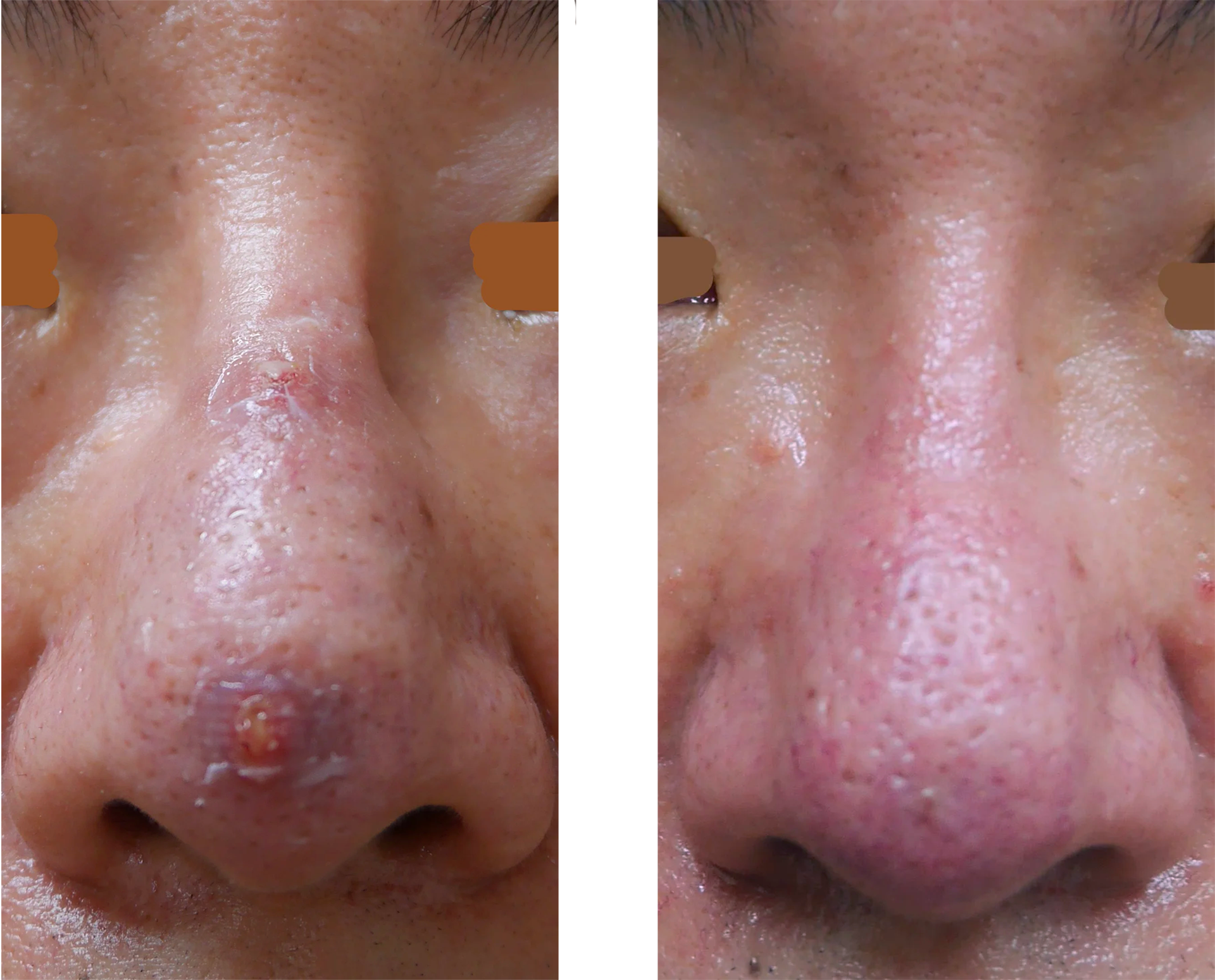 鼻瘤 びりゅう粉瘤・ほくろ除去で皮膚科をお探しなら はなふさ皮膚科へ