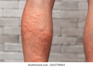 HAE 遺伝性血管性浮腫 とは 特徴・患者数・症状- 腫れ・腹痛ナビ武田薬品工業