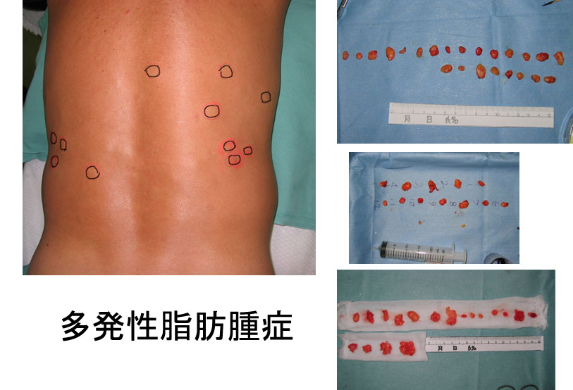 神経線維腫 Neurofibroma治療経過 – 医療法人 双英会 YUKI皮フ科形成外科一宮市時之島の皮膚科、形成外科
