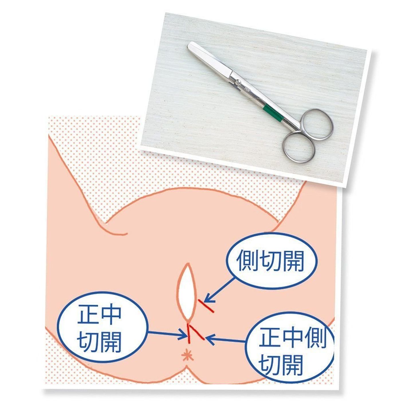 会陰切開のイラストイラスト - No: 22894958無料イラスト・フリー素材なら「イラストAC」