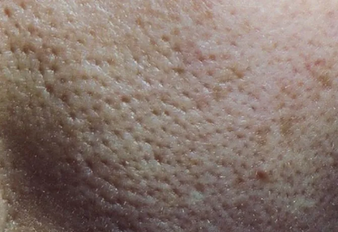 いちご鼻はホホバオイルで治せる？効果があるか43歳の毛穴で試してみた