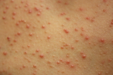 医療脱毛で毛嚢炎ができる原因と早く治す方法を医師が解説クレストスキンクリニック公式ブログ