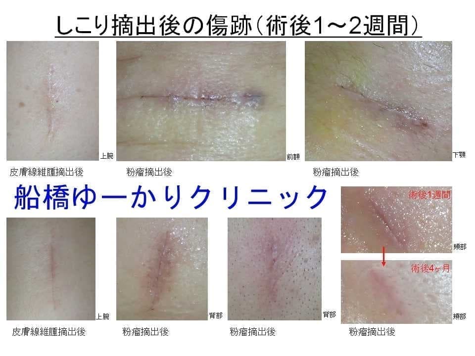 線維組織系腫瘍の手術を行うなら渋谷駅前おおしま皮膚科