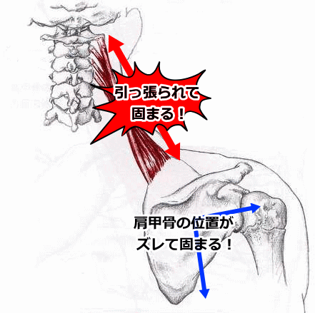 施術改善例 寝違えを解消するには腋窩神経がポイントだった東大阪の整体 からだリカバリーセンタ
