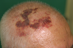 赤あざを早く治すセルフケアを紹介！内出血を早く治す食べ物や病気でできる赤あざの種類・治療方法も解説