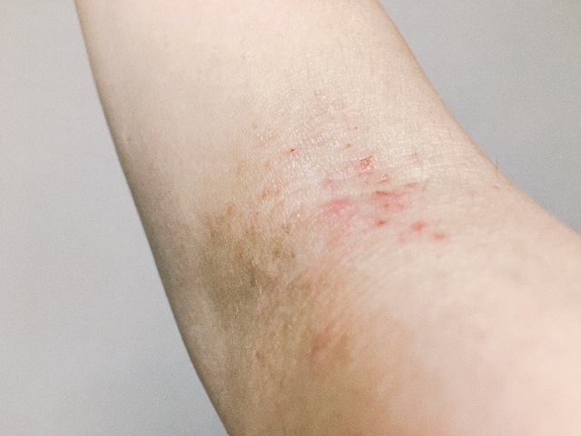 アトピー性皮膚炎について桜新町皮フ科クリニック