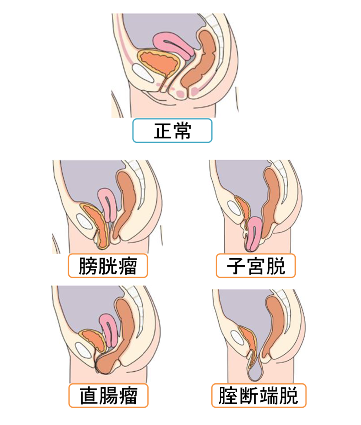 骨盤臓器脱について - 昭和大学横浜市北部病院 女性骨盤底センタ