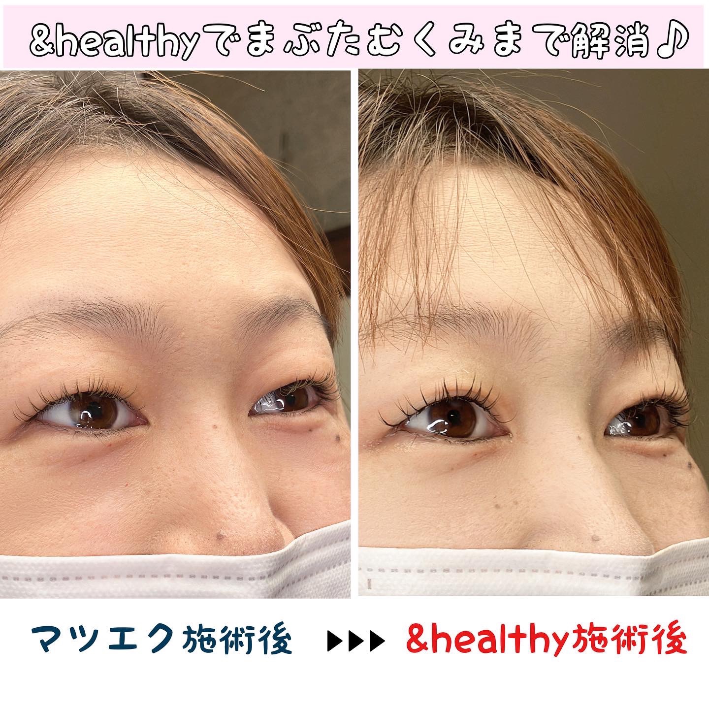 腫れぼったい瞼を持ちあげる！ まつげパーマ術 瞼と毛穴・ロットの厚みを 本格的に研究！ 腫れぼったい瞼を攻略した まつげパーマ技法を学ぼう！@doubleeyelift 切らずに二重をサポートするまつげパーマダブルアイリフト 骨膜＋毛穴矯正による最新技法 体験したい方は