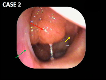 鼻の穴の入口が痛い かゆいに効く！メディクイックNロート製薬: 商品情報サイト