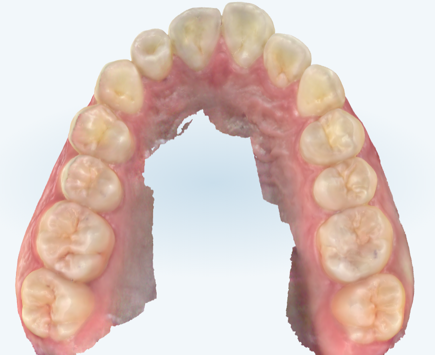 子供の二重歯列 二枚歯 とは？乳歯が抜ける前に永久歯が生えてきた - 子ども専門の歯ならび・矯正なら大田区田園調布のABC Dental