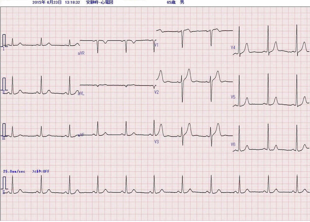 重症不整脈 無脈性VTとVf のアルゴリズムと対応のポイントナース専科