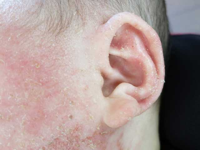 手足の皮むけ - 大阪西区の皮膚科・形成外科クリニック