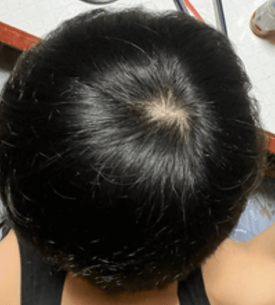どこからつむじハゲ？男性と女性の基準や見分け方を写真・画像で解説吉祥寺でAGA・薄毛治療ならスーパースカルプ発毛センター吉祥寺駅前店 公式