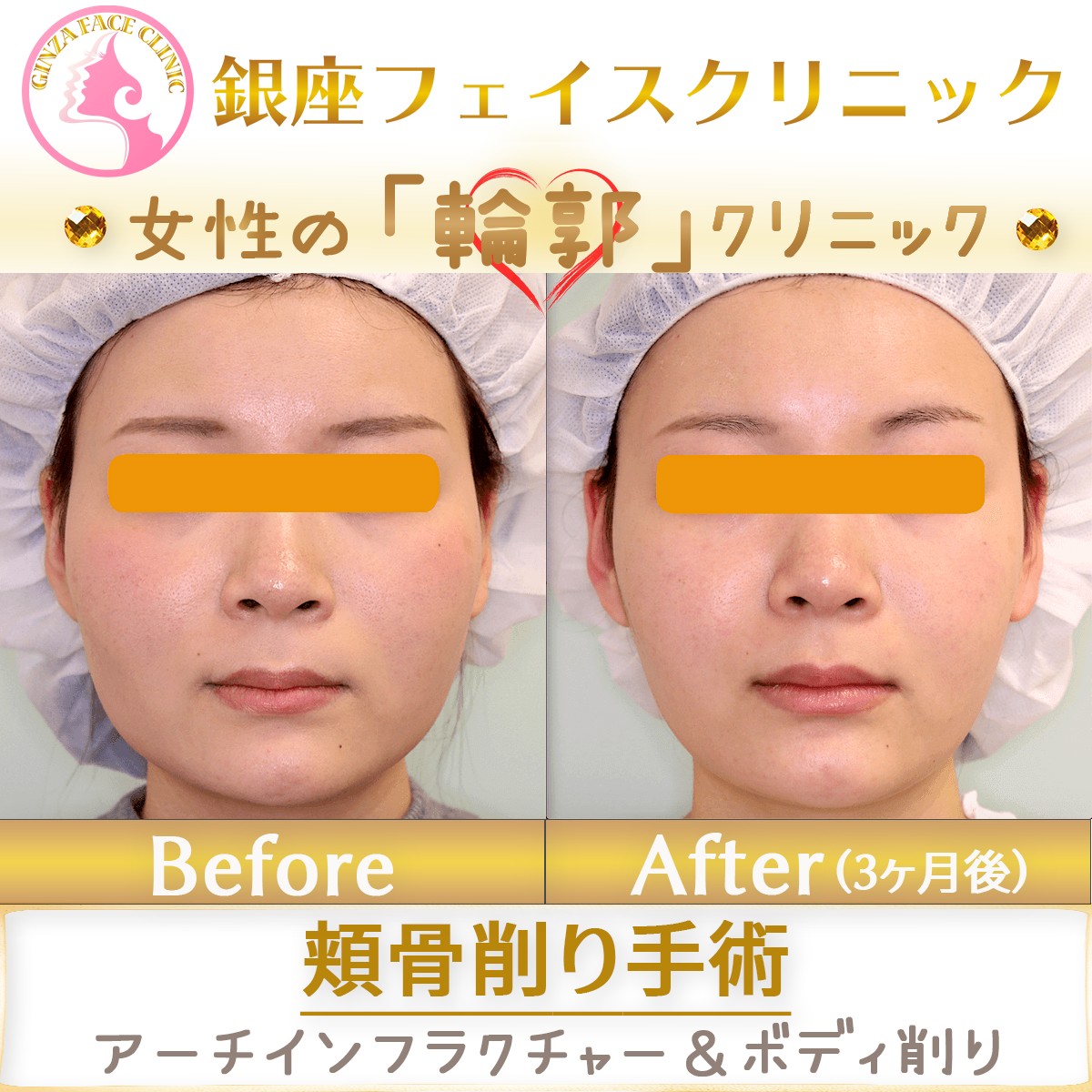 フェイスリフト＋エラのボトックス注射の症例写真・費用・リスク・副作用美容整形なら水の森美容クリニック 公式