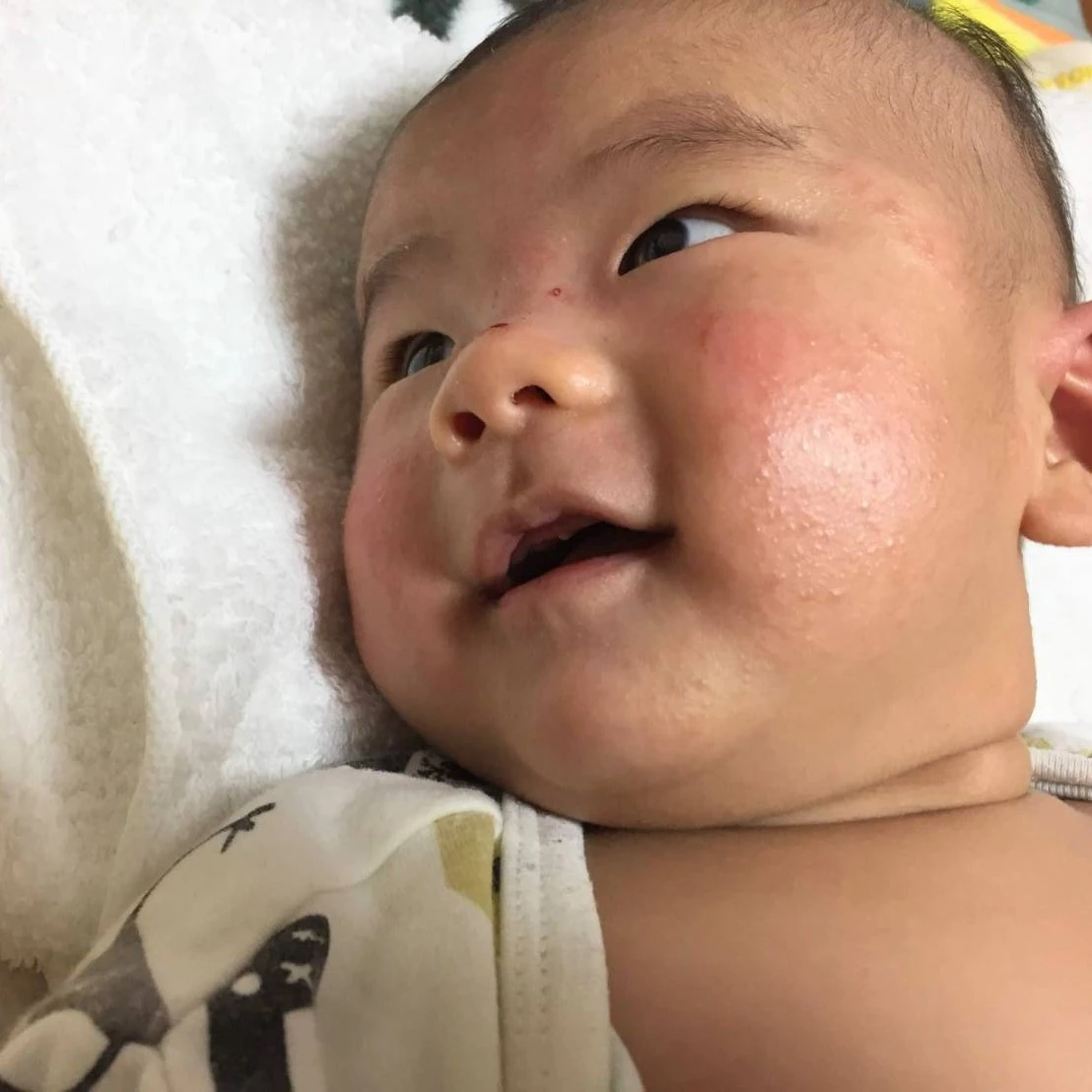 医師監修 赤ちゃんのよだれかぶれの原因や症状は？適切なスキンケアで対策を！マンビーノ mambino ドルチボーレ育児メディア