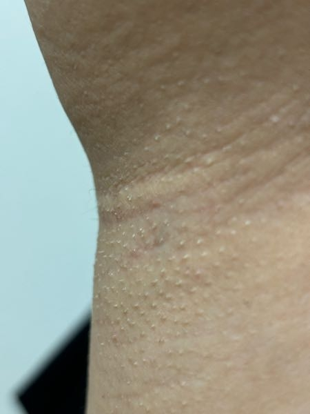 脇のブツブツの治し方とは？白い・赤い・黒いブツブツの正体も解説ハダメディア by BIHADADO.TOKYO