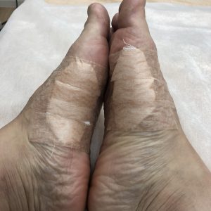 水ぶくれを潰すのはだめ！辛い靴擦れや皮めくれをを早く治すには？ – FOREMOS