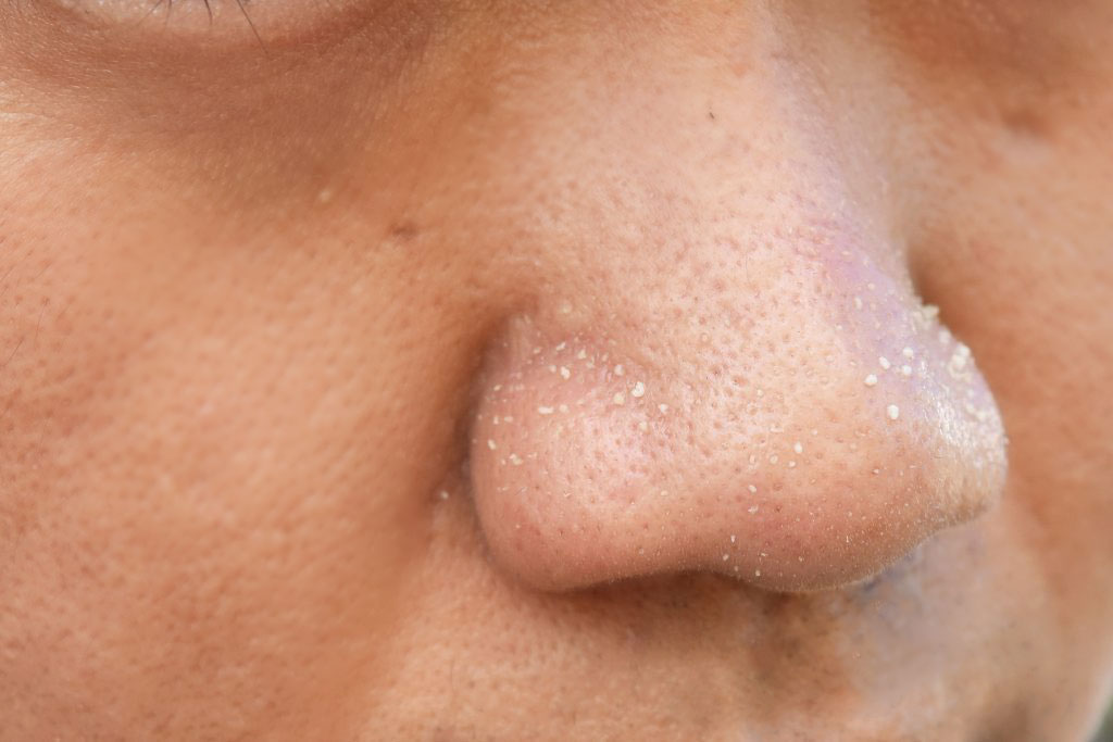 洗顔後の「毛穴の白いポツポツ」の取り方を解説！取れない場合の正しい対処法とはハダメディア by BIHADADO.TOKYO