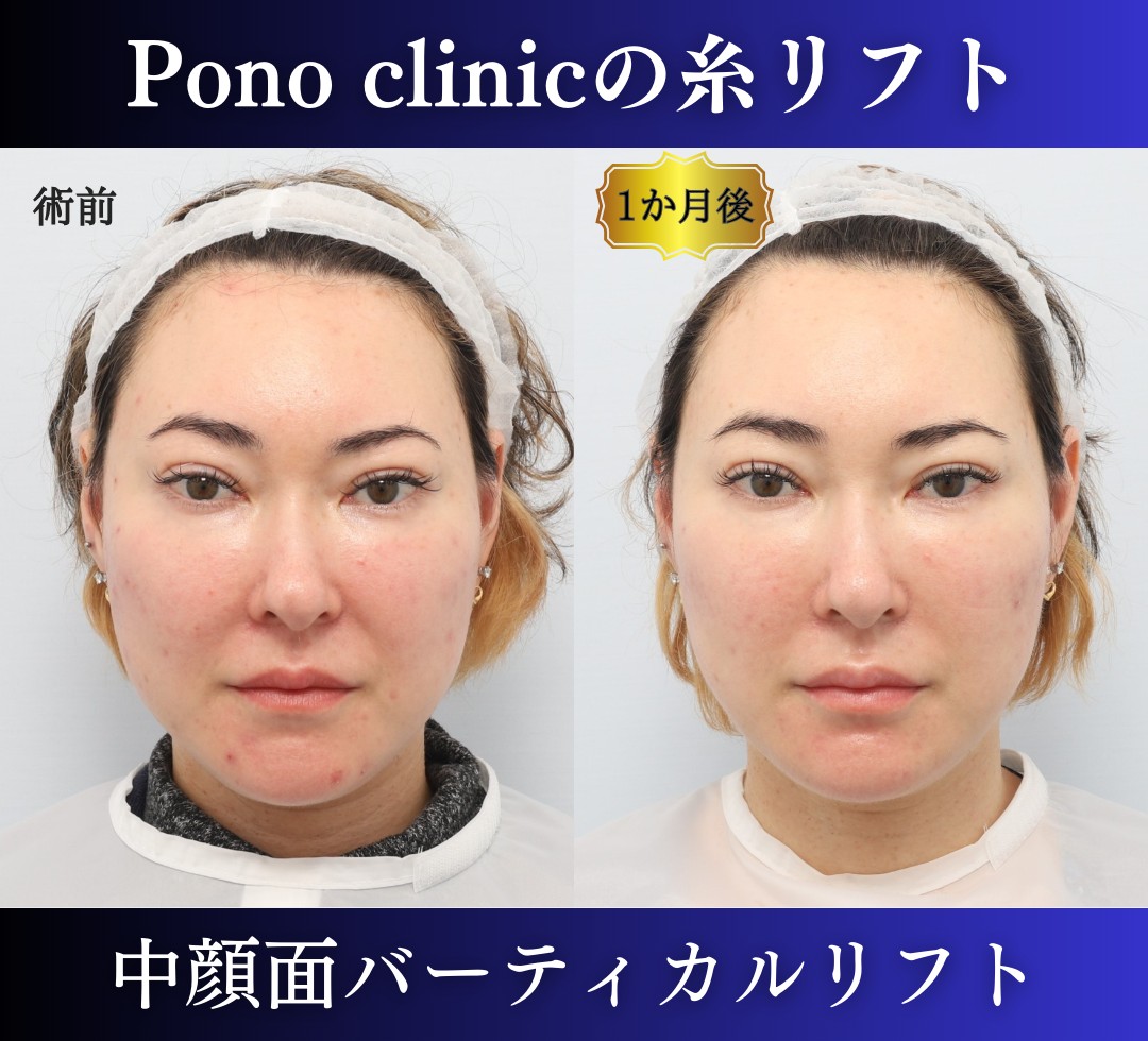 頬肉・顔肉を落とす方法は?笑った時の頬の肉が気になる方必見!公式 ASTRA BEAUTYCLINIC アストラビューティクリニック 美容外科・美容皮膚科・形成外科渋谷駅前
