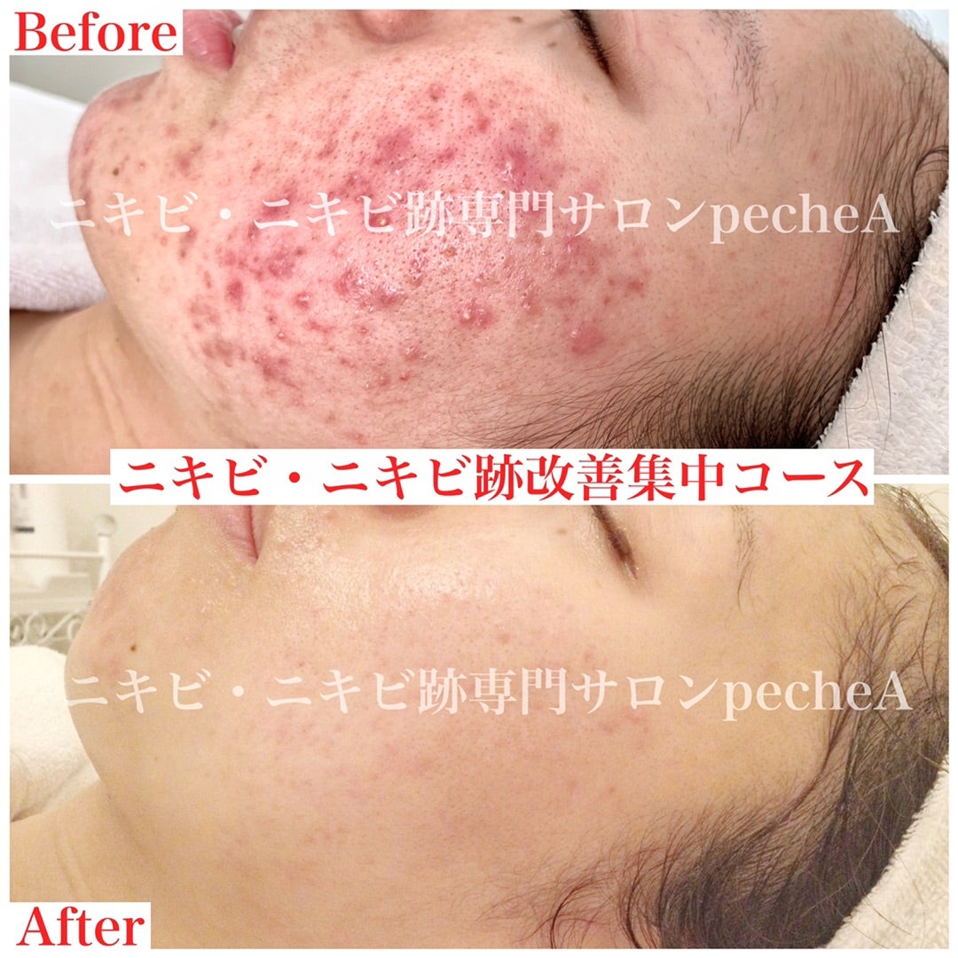 20代の女性ニキビ、ニキビ跡、毛穴の開き、お肌のガサガサがお悩みという症例です。, 治療前とアオハル式治療を4ヶ月間行った後の写真です。,以下4ヶ月間の治療内容です。, アオハル式, ケミカルピーリング7回79,200円, VCB2B6のイオン導入 7回46,200円,IPLフォトフェイシャル2回56,100円, 治療費は合計で181,500円,初回価格、コース価格等含まれます ,