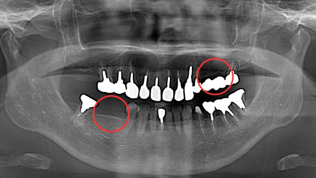 インビザラインの部分矯正に関する全知識を歯科矯正医が徹底解説インビザライン マウスピース矯正 専門の矯正歯科 - 医療法人社団dentalhealth care