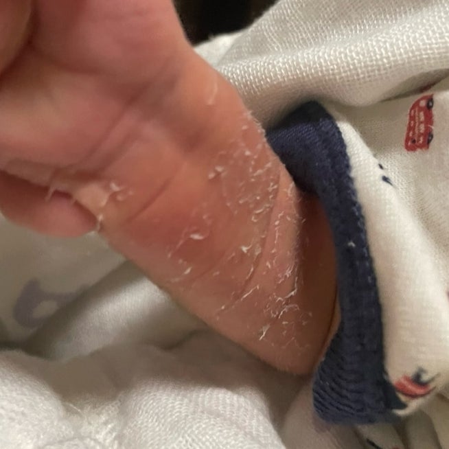 カサカサしたオデコや顔や頭の発疹野田市 小児科 千葉県 こどもの花粉症 こどもの漢方 喘息 アトピー性皮膚炎 アレルギー 結節性痒疹たんぽぽこどもクリニック