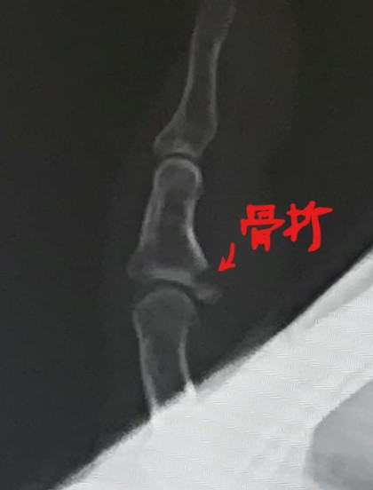 手指基節骨骨折 こけて指が変形しちゃった！- 古東整形外科・リウマチ科