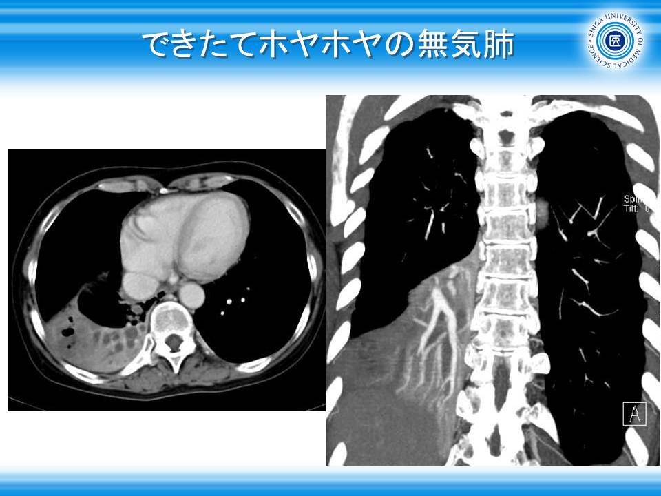 無気肺について横浜弘明寺呼吸器内科クリニック健康情報局